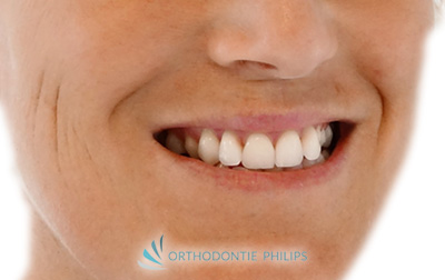Sourire avant traitement orthodontique