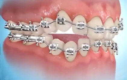 appareil orthodontique multibagues pour adulte