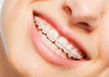sourire d'une femme avec appareil dentaire à bagues en céramique