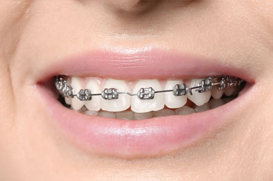appareil orthodontique en métal