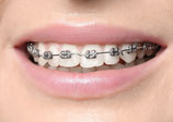 sourire d'une femme avec appareil dentaire à bagues métalliques