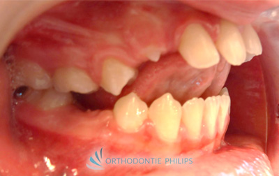 Alignement des dents - Profil droit - Avant traitement orthodontique