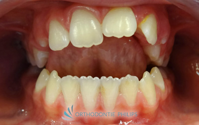 Alignement des dents - Vue de face - Avant traitement orthodontique