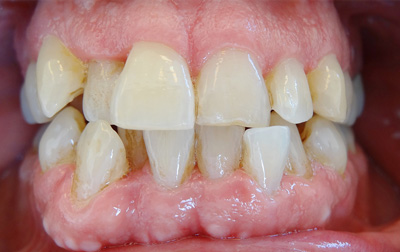 Dentition vue de face avant traitement invisalign