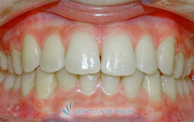 Alignements des dents après traitement Invisalign - Profil de face