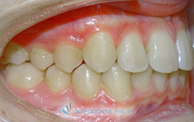 Alignements des dents après traitement Invisalign - Profil droit