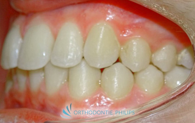 Alignements des dents après traitement Invisalign - Profil gauche