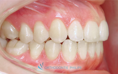 Alignement des dents - Vue profil droit apres traitement Invisalign