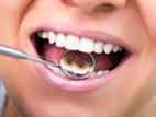sourire d'une femme avec appareil dentaire Lingual